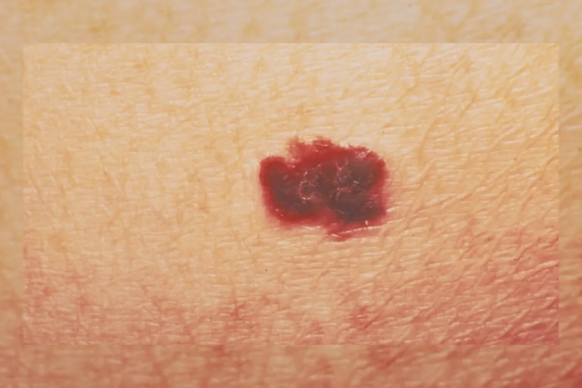 FDA AS Setujui Obat Kanker Kulit Buatan Replimune untuk Melanoma Lanjut