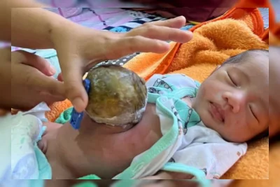 Bayi Pengembala Pandeglang dengan Kelainan Usus Butuh Donatur