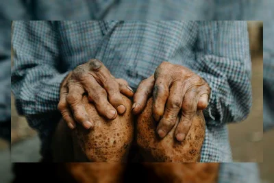 Menkes Targetkan Temuan Kasus Kusta Naik hingga 40.000/Tahun