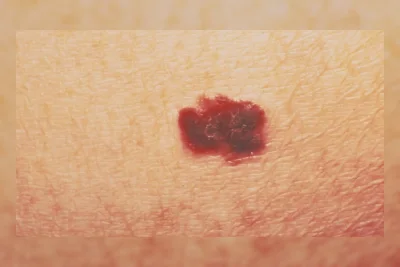 FDA AS Setujui Obat Kanker Kulit Buatan Replimune untuk Melanoma Lanjut