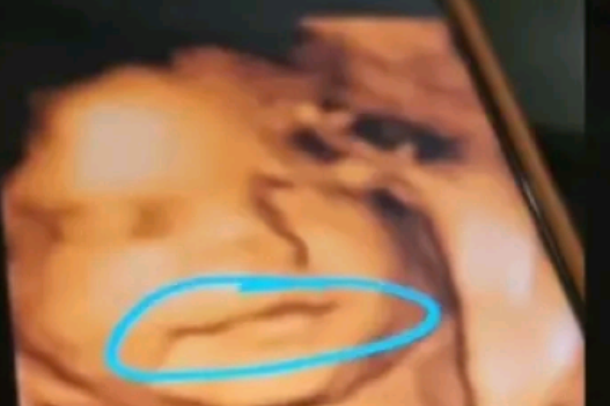 Viral Video Pasangan Alami Kehamilan 9 Bulan Tapi Bayi Mendadak Hilang, Begini Penjelasan Medisnya